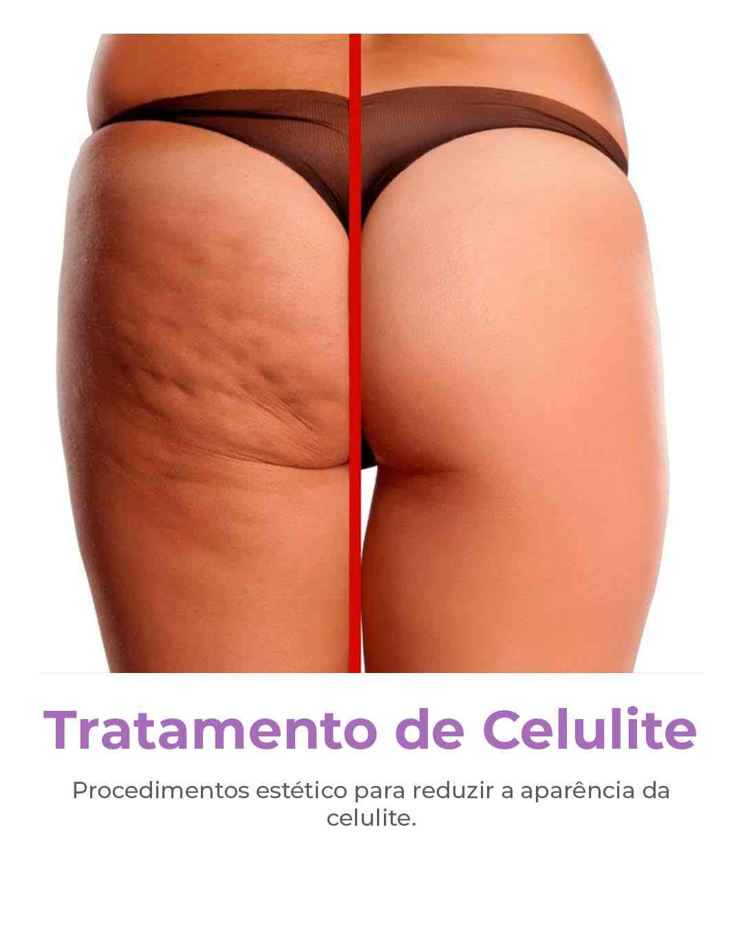 Tratamento de celulite-compressed